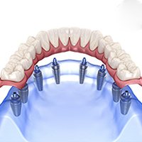 All on 8 dental implants in Ho Chi Minh City