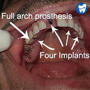 Full arch prothesis - all on 4