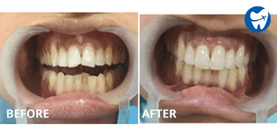 Dental Veneers in New Delhi: Before and After