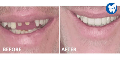 Dental Crowns in New Delhi: Before and After