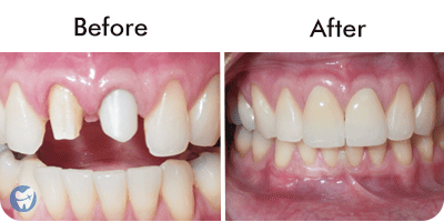 Front teeth crowns - Before & After