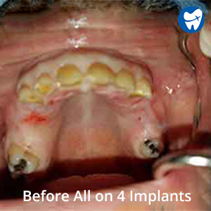 Before-All-on-4-Implants