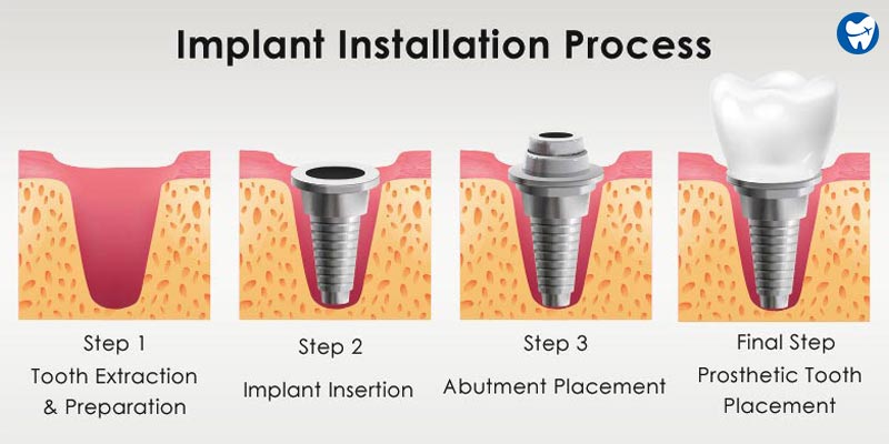 Dental implant installation process
