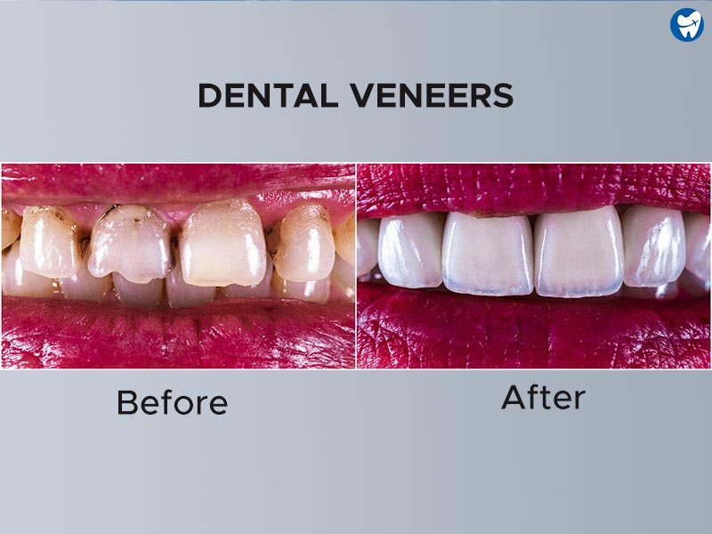 Dental veneers - Before & After