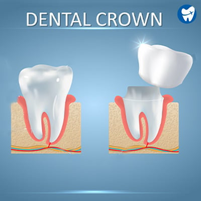 Dental Crown in Puerto Rico