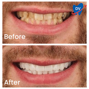 Male Hollywood Smile Results
