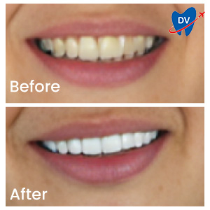 Dental Crowns in Istanbul Before and After