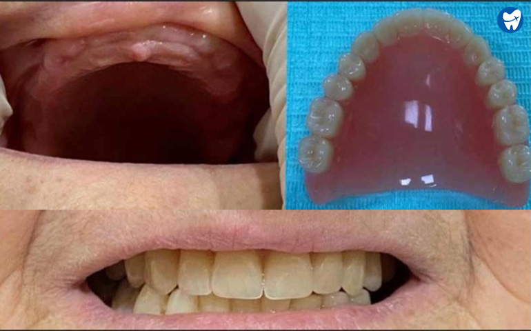 Removable Complete Denture – Before & After
