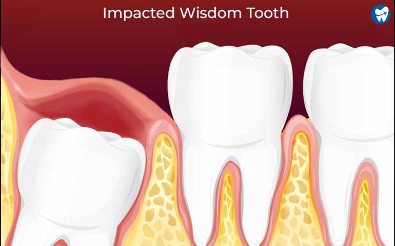 Impacted-Wisdom-Tooth
