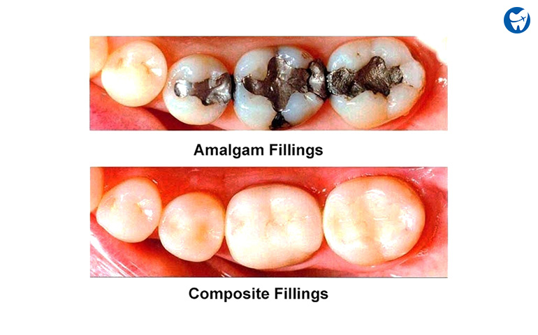How Much Do Dental Fillings Cost  