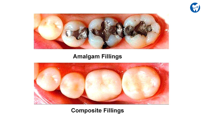 Different types of tooth fillings