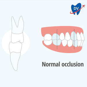 Normal occlusion