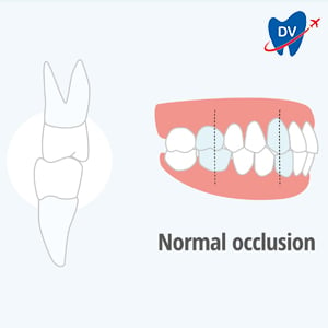 Oclusión normal