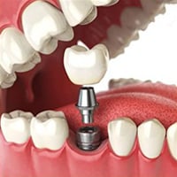 Single tooth implant