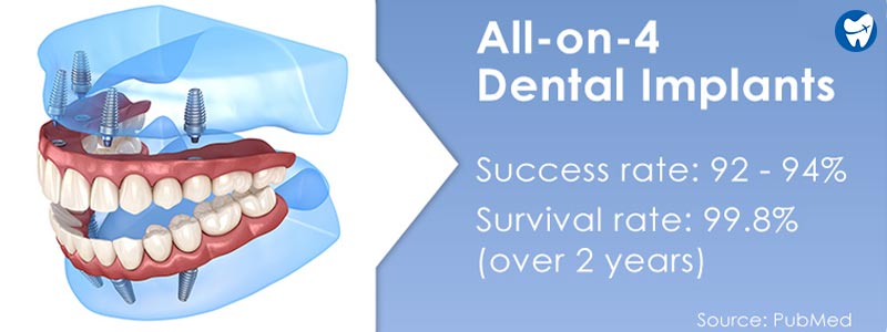 Success rate of all on 4 dental implants