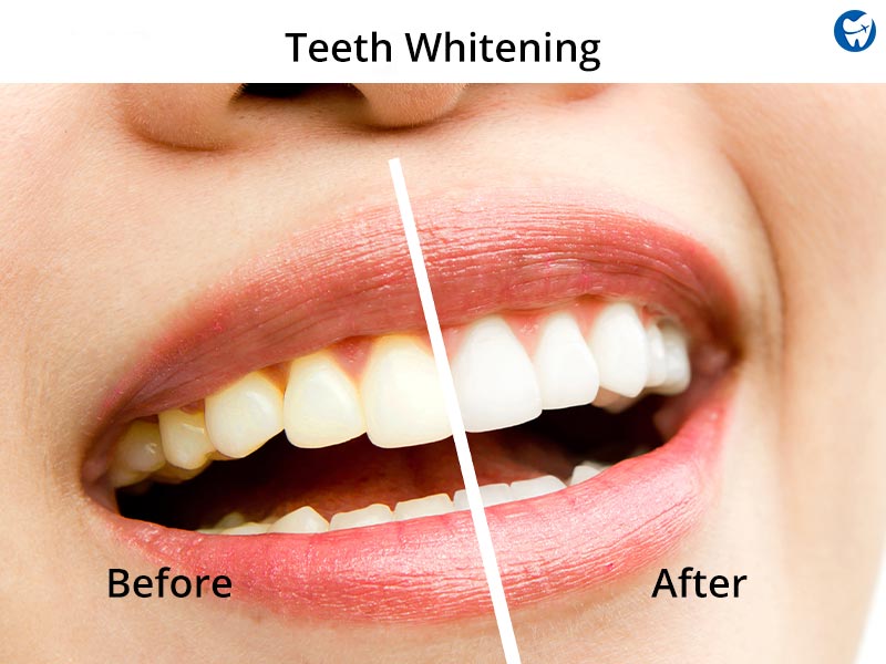 Teeth whitening - Before & After
