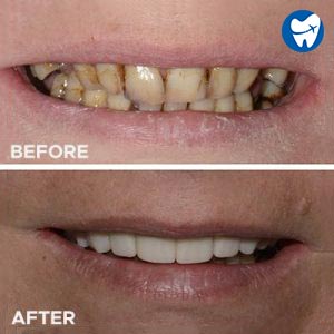 Zirconia crowns - before and after