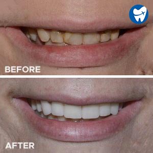 Zirconia crowns - before and after