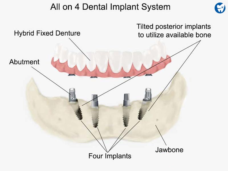 All on 4 dental implant system