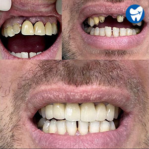 Dental Bridges Before & After in Albania