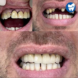 Dental Crowns and Bridge – Before and After