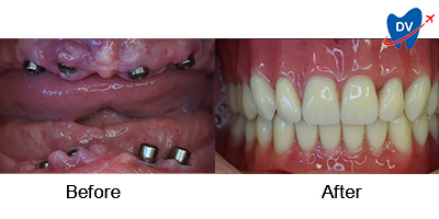 Before & After: Dental Implants in Hungary