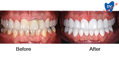 Before & After Teeth Whitening in Vietnam