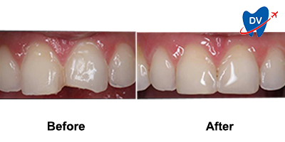 Before & After: Dental Crowns in San Jose