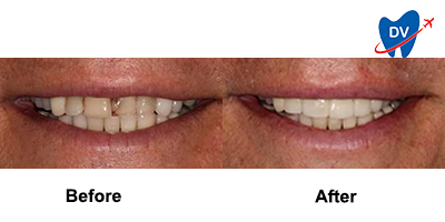Before & After: Dental Crowns in Colombia