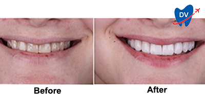 Before & After: Teeth Whitening in Brazil