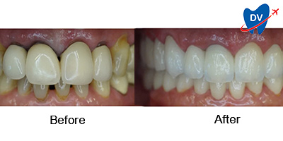 Before & After Image of Dental Bridge in Hungary