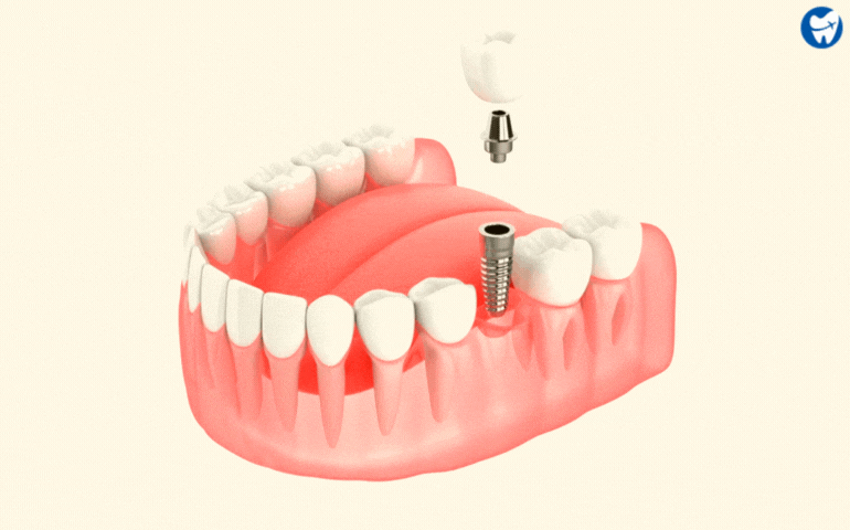 Cheap Dental Implant Placement in the US