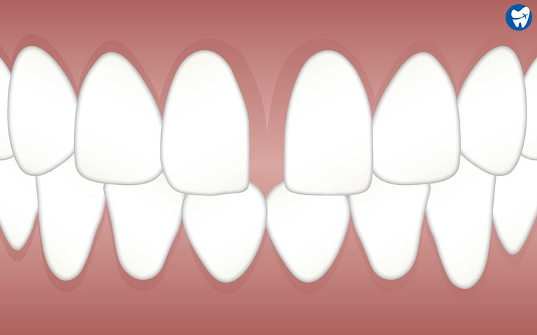 Gap between teeth 