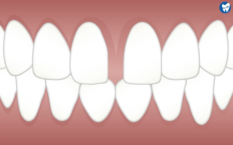 Gap between teeth 