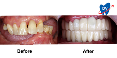 Dental Bridge in Thailand Before & After