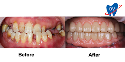 All-on-4 Dental Implants in Thailand Before & After