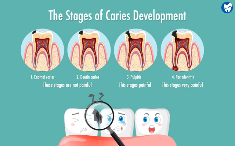 Stages of dental caries
