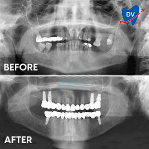 X ray of all on 4 implants in Croatia - Before & after
