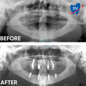 X ray of full mouth reconstruction— All-on 4 Implants in Croatia Before & after