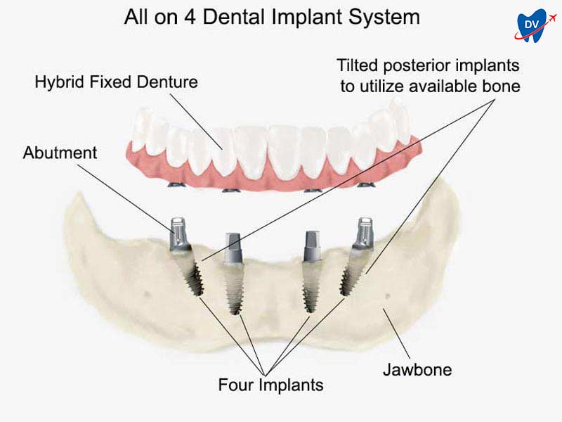 All on 4 dental implant system