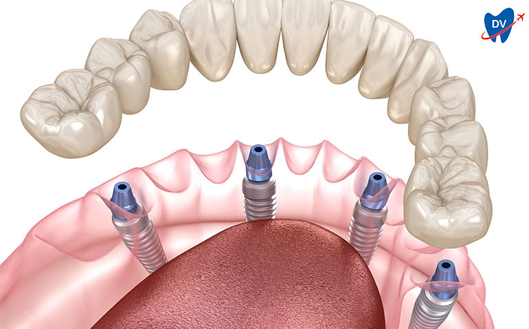 All on 4 Dental Implants in Nogales