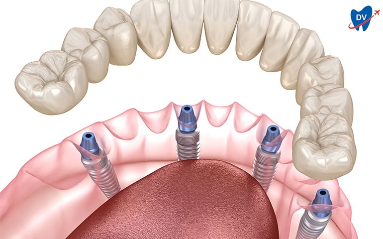 All-on-4 Dental Implants