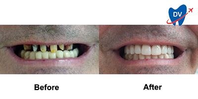 Before & After: Dental Crowns in Sofia