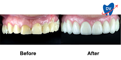 Tooth Crowns in Poland Before & After