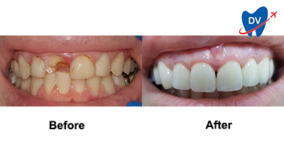 Before & After: Dental Crowns in Georgia