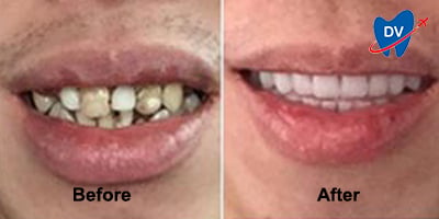 Before & After Image of Dental Crowns