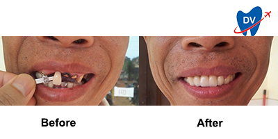 Before & After: Dental Implants in Cambodia