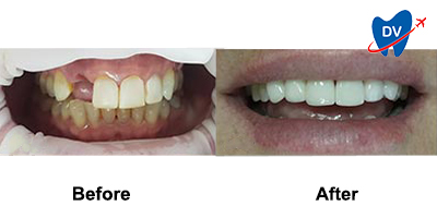 Before & After: Dental Implants