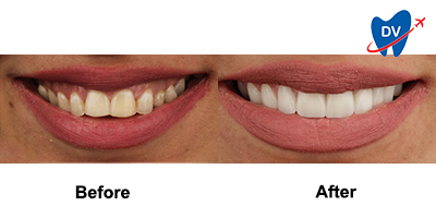 Before & After: Dental Veneers in Egypt