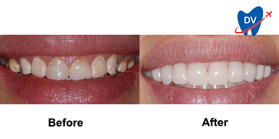 Before & After: Dental Veneers in El Salvador